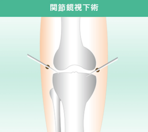 膝 内視鏡