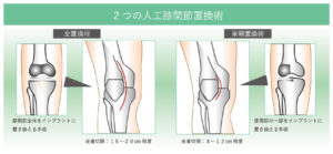 変形性膝関節症における人工膝関節置換術（TKA・UKA) - 整形外科医師