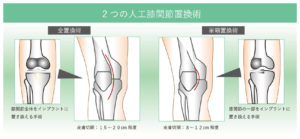 変形性膝関節症に対する人工膝関節置換術後の理学療法【DVD4