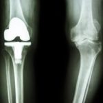 変形性膝関節症における人工膝関節置換術(TKA・UKA)