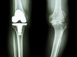 変形性膝関節症における人工膝関節置換術（TKA・UKA)