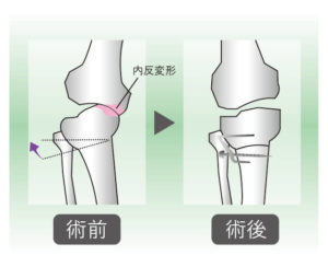 外反骨切り術