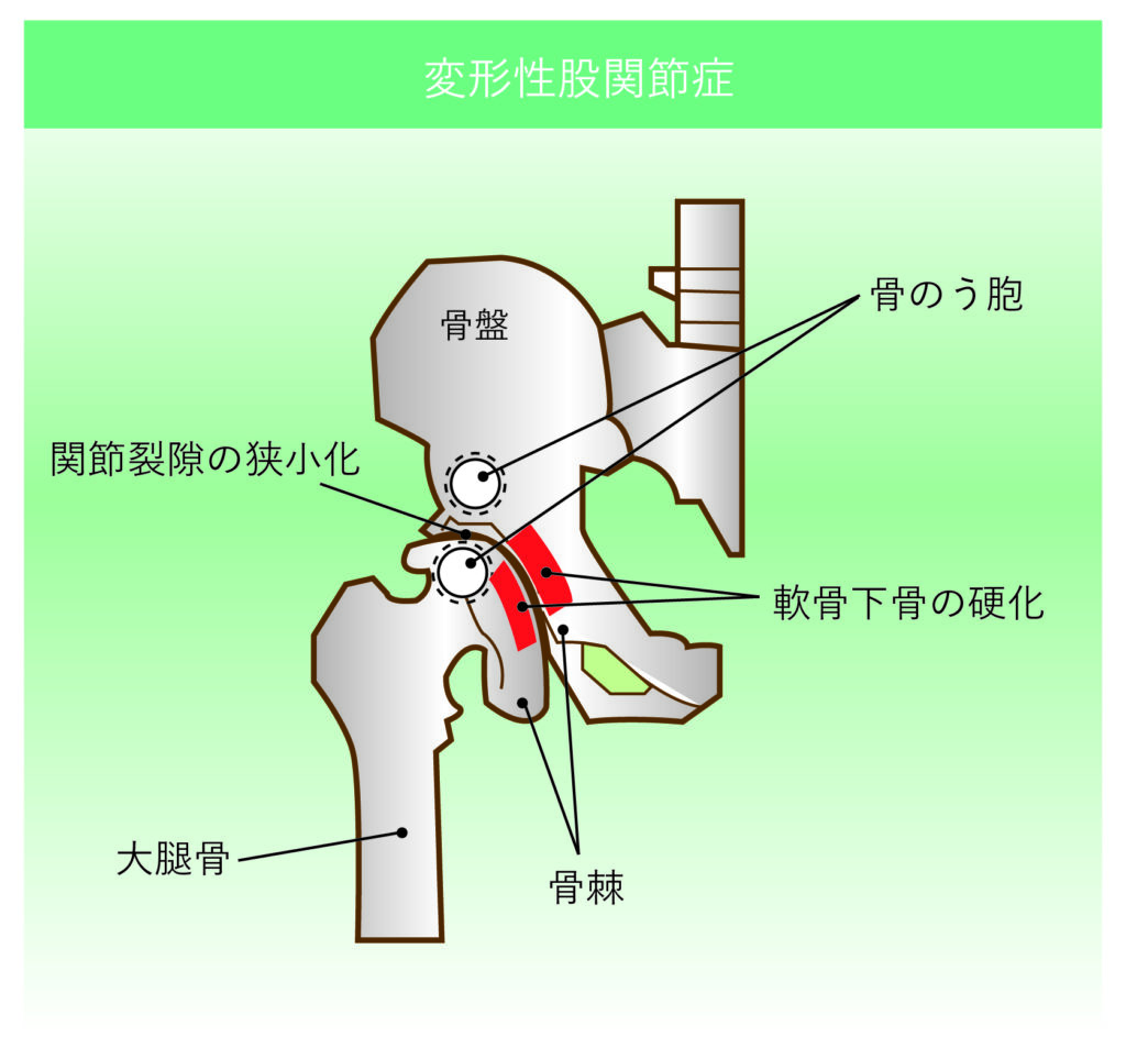股関節の変形